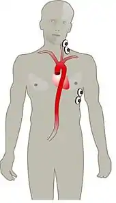 Electrode array that measures Thoracic electrical bioimpedance (TEB)