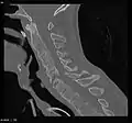 CT scan showing bamboo spine in ankylosing spondylitis