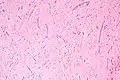 Atrial myxoma. H&E stain.