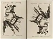 French caricature of Napoleon III, 1870.