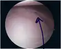Bankart lesion seen at arthroscopy