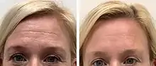 A patient's forehead lines and wrinkles before/after botox.