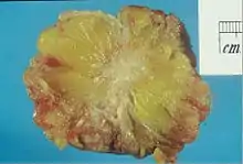 Excised human breast tissue, showing an irregular, dense, white stellate area of cancer 2 cm in diameter, within yellow fatty tissue