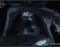 Chest MRI showing a hemothorax in a 16-day-old infant