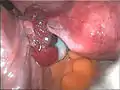 Dye visible in the fallopian tube