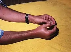 Swollen right hand after having been punctured