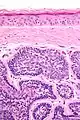 Micrograph of dermal cylindroma in H&E stain.