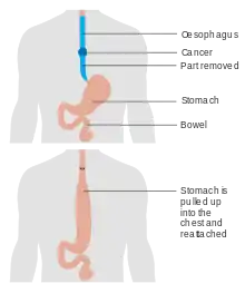 Diagram showing before and after a total oesophagectomy