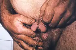 Man showing signs of hypospadias, including a bifid penis
