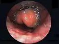 Swollen epiglottis in laryngoscopy