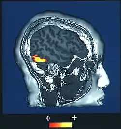 A side-on image of an fMRI scan of a human brain.