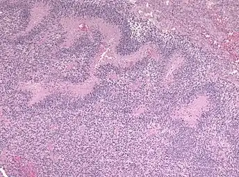 Pseudopalisading seen around necrosis in glioblastoma
