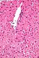 Micrograph showing ground glass hepatocytes. H&E stain.