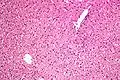 Micrograph showing ground glass hepatocytes. H&E stain.