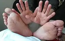 Rash on hand and feet of a 36-year-old man