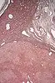 Micrograph of hepatic adenoma. Reticulin stain