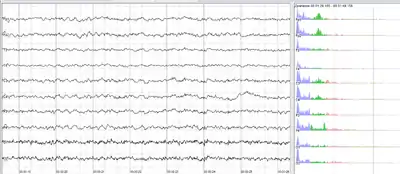 Human EEG with in resting state. Left: EEG traces (horizontal – time in seconds; vertical – amplitudes, scale 100&nbsp;μV). Right: power spectra of shown signals (vertical lines – 10 and 20&nbsp;Hz, scale is linear). 80–90% of people have prominent sinusoidal-like waves with frequencies in 8–12&nbsp;Hz range – alpha rhythm. Others (like this) lack this type of activity.
