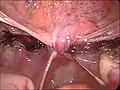 End of a laparoscopical hysterectomy