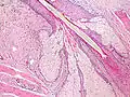 Insertion of sebaceous glands into hair shaft