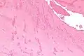 Low magnification micrograph showing laminations in a thrombus in a fatal pulmonary embolism. H&E stain.