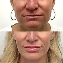 Lip augmentation before/after.