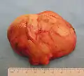 The resected lipoma(8&nbsp;cm × 6&nbsp;cm × 3&nbsp;cm)