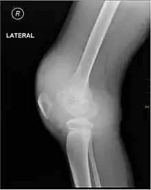 X-ray of Hemarthrosis