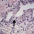 Adenocarcinoma with two mitoses in reactive epithelium.