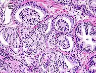 Gleason score 8 (4+4) with glomeruloid glands