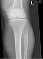 multiple osteochondromas around the knee