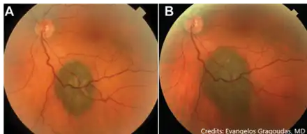 A: Lesion at initial presentation, height 1.1m. B: Same lesion, 7 years later. There is evidence of mild enlargement of basal diameter, but height remains stable. Lesion is continued to be observed without treatment.