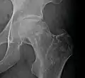 Radiography of avascular necrosis of left femoral head. Man of 45 years with AIDS.
