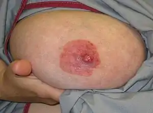 Paget's disease of the nipple