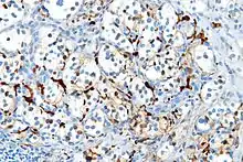 S100 immunostain highlighting the sustentacular cells in a paraganglioma
