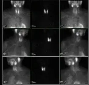 A nuclear medicine parathyroid scan demonstrates a parathyroid adenoma adjacent to the left inferior pole of the thyroid gland. The above study was performed with Technetium-Sestamibi (1st column) and iodine-123 (2nd column) simultaneous imaging and the subtraction technique (3rd column).
