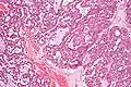 Polymorphous low-grade adenocarcinoma. H&E stain.