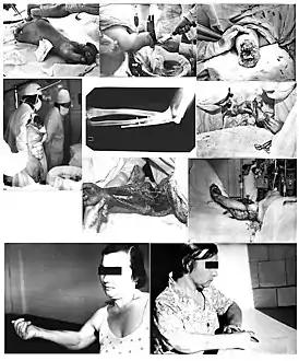 Professor Nicolai Volodos Replantation 1977