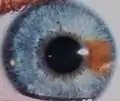 A young adult human exhibiting sectoral heterochromia in the form of an orange-brown segment in blue eye.