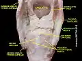 Aryepiglotic muscle
