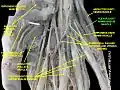 Flexor digiti minimi brevis muscle