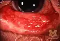 Conjunctivitis in SJS