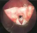 Grade 2 subglottic stenosis