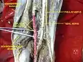 Common fibular (peroneal) nerve