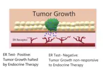 Tumor Growth