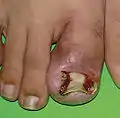 Ingrown toenail before Vandenbos procedure