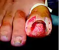 Intraoperative toe (ingrown toenail) during the procedure