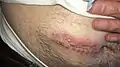 Belly wound at day 15, stitches removed