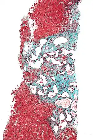 Low magnification micrograph of a bile duct hamartoma. Trichrome stain.