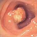 Photo of a polyp Photo of Polyp