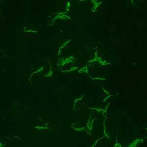 Positive IFA result with T. cruzi antigen (magnification 400x).